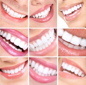 Overview of how dental veneers improved the overall appearance of teeth of our patients in Fairfax