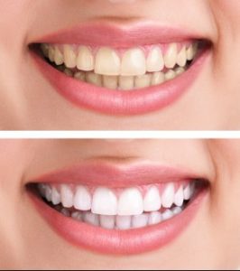 Teeth Whitening Service by Fair City Mall Dental Care
