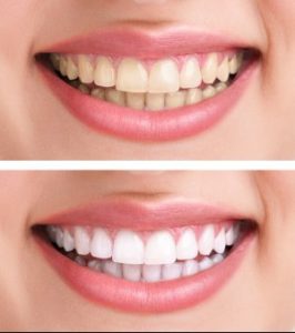 Teeth whitening transformation at Fair City Mall Dental Care, Fairfax, VA