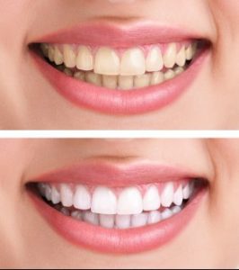 Teeth Whitening in Fairfax, VA