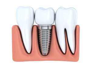 Dental Implant Service in Fairfax VA