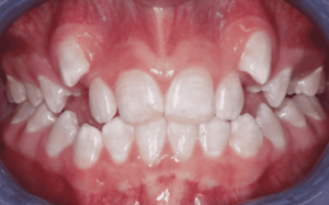 Abscessed teeth treatment in Fairfax, VA