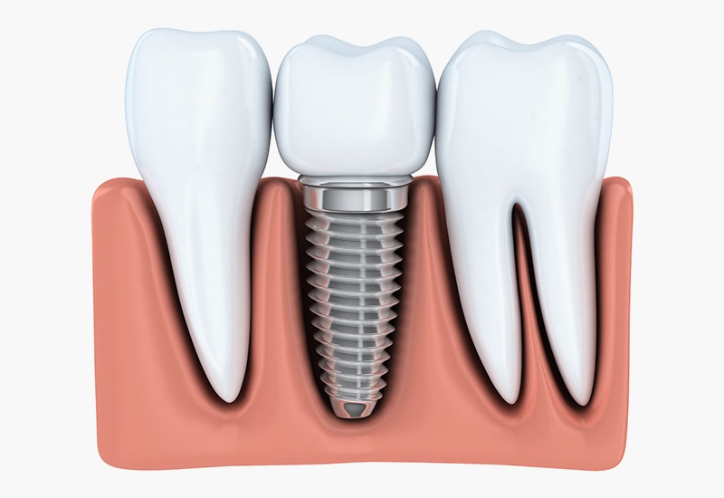 Dental Implants in Fairfax, VA