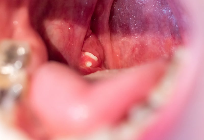 Close-up of a tonsil stone at Fair City Mall Dental in Fairfax, VA.